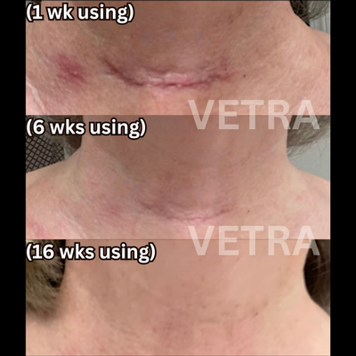 Vetra™ Scar Solutions Silicone Stick