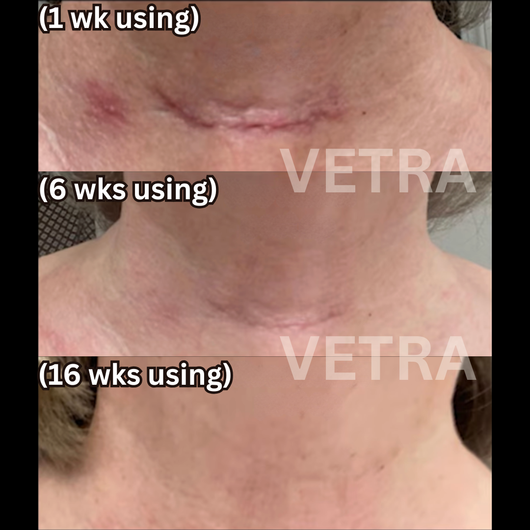 Vetra™ Scar Solutions Silicone Stick
