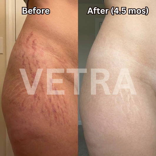 Vetra™ Scar Solutions Silicone Stick