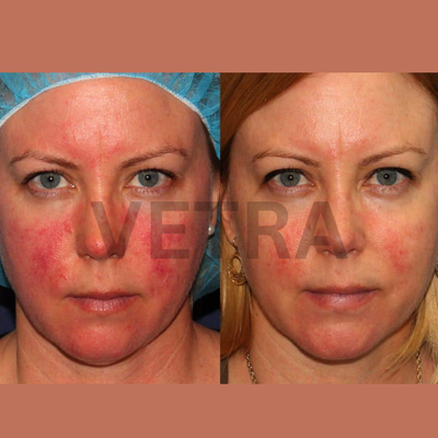 Vetra™ Silicone Rosacea Corrector