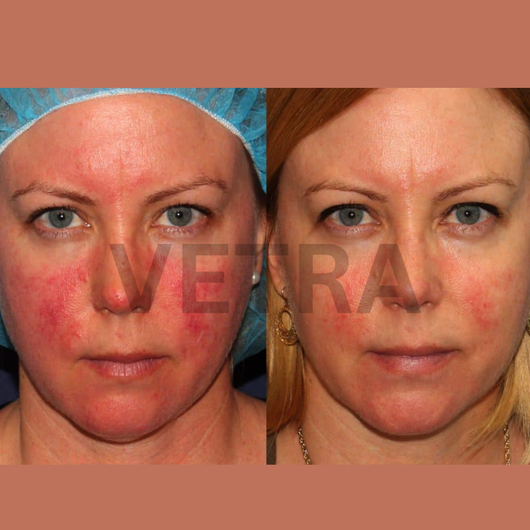 Vetra™ Silicone Rosacea Corrector