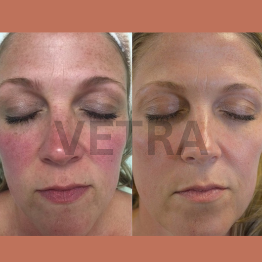 Vetra™ Silicone Rosacea Corrector