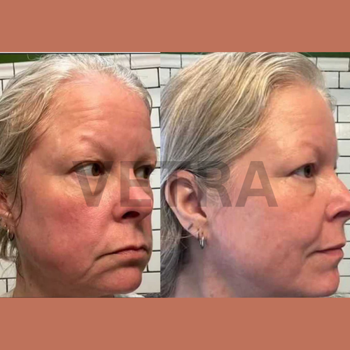 Vetra™ Silicone Rosacea Corrector