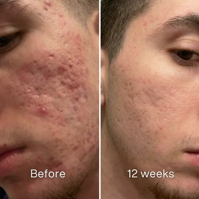 Vetra™ Acne Scar Remodeling Stick