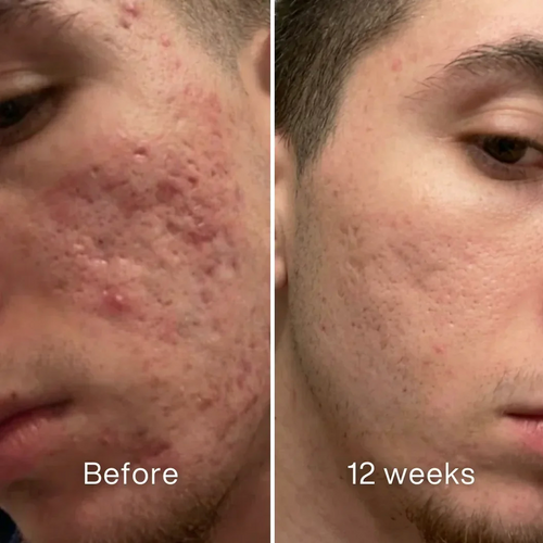 Vetra™ Acne Scar Remodeling Stick