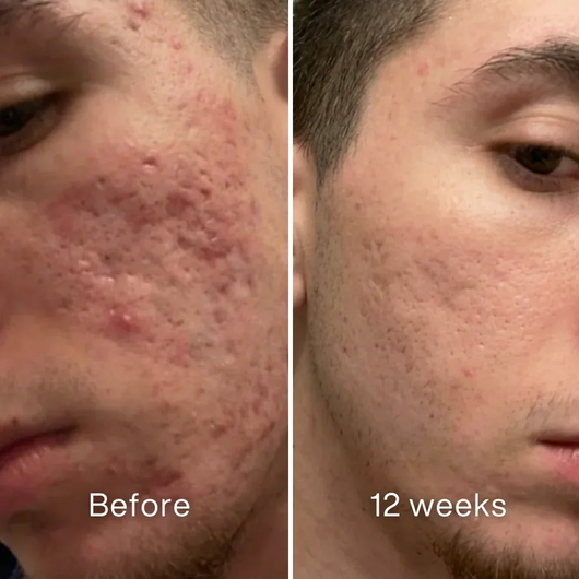 Vetra™ Acne Scar Remodeling Stick