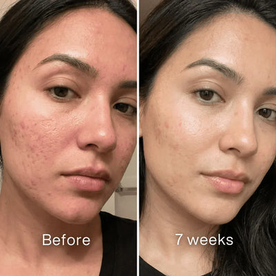 Vetra™ Acne Scar Remodeling Stick