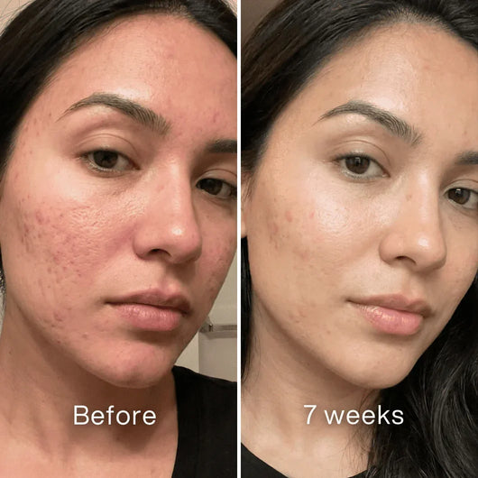 Vetra™ Acne Scar Remodeling Stick
